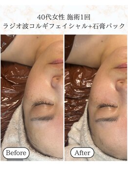 シーフェイス 横浜店(SEE FACE)/ラジオ波小顔コルギ+石膏パック