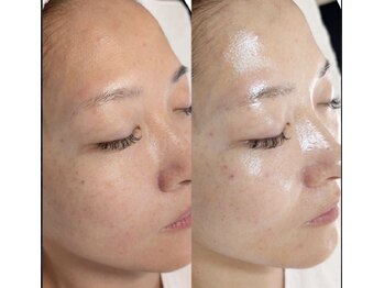 ユラン(YURAN)/韓国発セラピールbefore→after