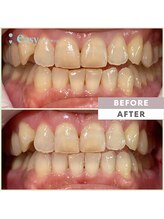 イージーホワイトニング 五反田店(easy whitening)/セルフホワイトニング症例写真