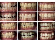 コトハ/セルフホワイトニング症例集3