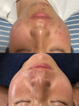 ユウユウ(YUYU)/手強いニキビ、撲滅させます。