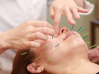 いちまる鍼灸院/美容鍼 即時効果 小顔