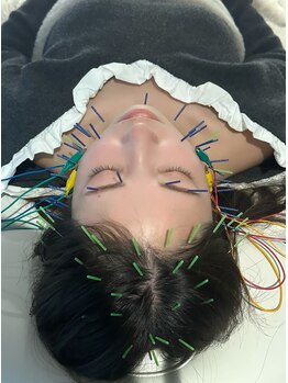 チョコバリ 渋谷店(chocobari)/小顔×リフトアップ(美容鍼)20代