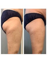 美温(mion)/キュキュッとヒップアップ