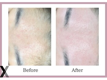 クロス(Xcross)/フェイスワックス【毛穴/渋谷】