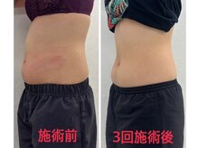 ビオナス(BIONAZ)/脂肪冷却のみで3回