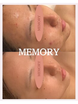 メモリー(MEMORY)/ニキビ0肌へ☆