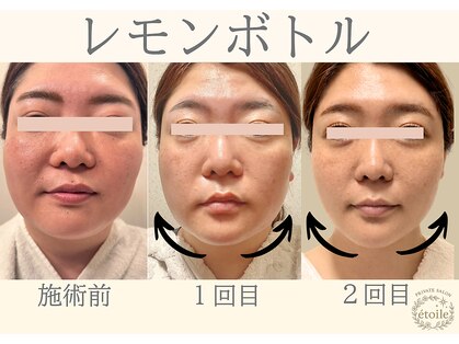 エトワール(etoile)の写真