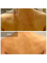 リバース(Rebirth)/背中のニキビケア