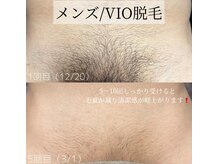 カナウ(KANAU)の雰囲気(濃いVIOもツルッと仕上げます♪目安約5~10回(6ヶ月間)で完成!)