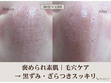 レガロビューティクリエイションズ桜川店/褒められ素肌│毛穴ケア