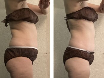 お気軽ビューティエーヴィヒ(Ewig)/【痩身】ビフォーアフター