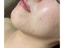 ビューティーサロン アンド ユー シブヤ(Beauty Salon&U Shibuya)/クリスティーナ施術6回後