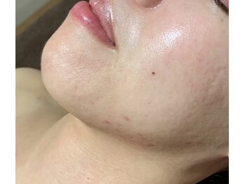 ビューティーサロン アンド ユー シブヤ(Beauty Salon&U Shibuya)/クリスティーナ施術6回後