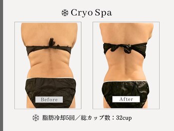 クリオスパ 豊春店(Cryo Spa)/脂肪冷却Before/After