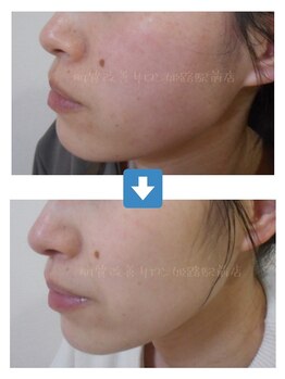 肌質改善サロン 姫路駅前店/改善写真（赤み.クスミの緩和）