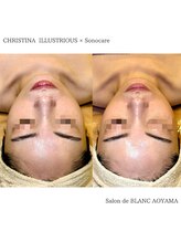 サロン ド ブラン アオヤマ(Salon de BLANC AOYAMA)/クリスティーナ美白ケア