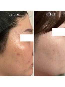 マーギアー(Magier)/ハーブピーリング初来店→３回目