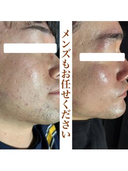 ハーブピーリングHY/メンズフェイシャル