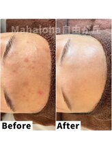 マハロハ 自由が丘(Mahaloha)/【ニキビ・肌荒れ跡ケア施術】