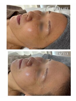 ソア/【ハリ/艶肌】韓国肌管理2回