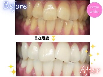 エクシアホワイトニング 天神店/ビフォーアフター　6カ月後