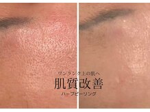 エングロー 錦糸町店(Englow)の雰囲気（美の定番・ハーブピーリング毛穴・ニキビ改善促進）