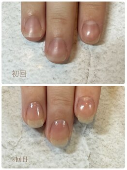 ソネル(SONEL)/美育爪矯正(育成)