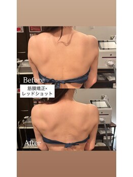 白美/筋膜矯正×レッドショット
