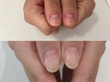 エスネイル(S-nail)/深爪矯正/自爪育成