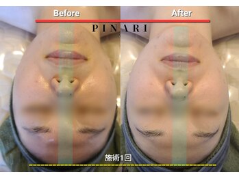 ピナリ(PINARI)/コルギ/小顔矯正/リフトアップ