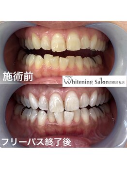 ホワイトニングサロン 京都烏丸店/ホワイトニング施術例