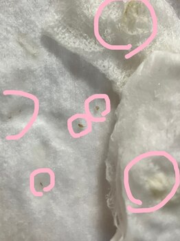 KMB 中崎町店/毛穴エクストラクションモンロー