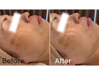 グレイス 高槻店(GRACE)/水光肌ピール1回目