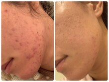 エミルカ 北谷店(EMILUCA)/ハーブピーリング3回効果