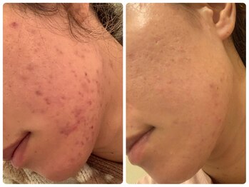 エミルカ 北谷店(EMILUCA)/ハーブピーリング3回効果