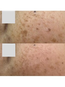 ブレス イオン酒田南店(BLESS)/結果の出るシミケア