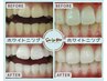 【セルフホワイトニング】再来の方☆ワントーンから5トーンUP♪