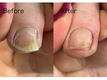 ロンディネ(Rondine)/巻き爪ケア&Nail trim