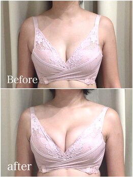 エヌエー 米子店(na)/光豊胸×バスト筋膜リリース