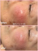 ミレボ(Me.rebo)/復元パック　before→after