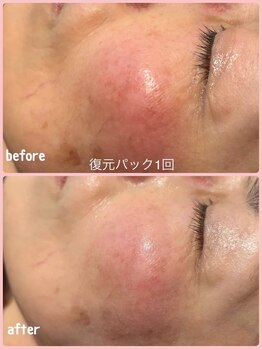 ミレボ(Me.rebo)/復元パック　before→after