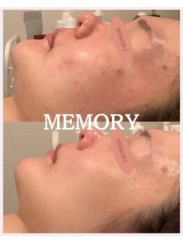 メモリー(MEMORY)/ニキビゼロ、トーンアップも☆