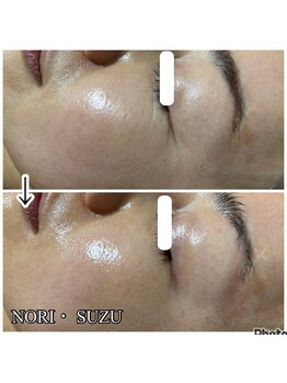 ノリスズ(NORI SUZU)/エクソソーム配合ヒト幹細胞 1回