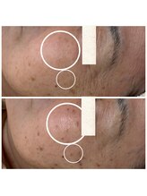 ビースキン(be-skin)/シミケアbefore→after