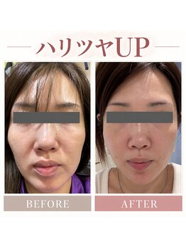 カエラ(KAELA)の写真/たるみがちなお肌の引き締め/たるみ毛穴のケア/ツヤ肌/弾力があり瑞々しい肌に