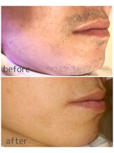 セカンドフロア バイ ブレスト ハコダテ(2nd floor by BLESSED HKD)/面倒なヒゲ剃りから卒業