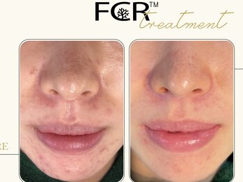 ワイキューマルサン(y903)/【FCRハーブピーリング】