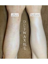 アロー(Allo!)/ひじ下WAX脱毛