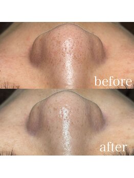 ビエン(bien)/本気の毛穴革命で毛穴引き締め